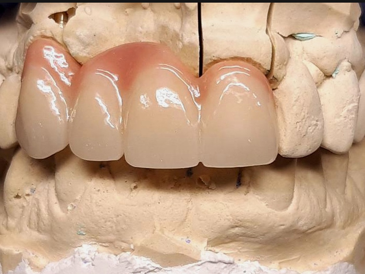 Puente estético anterior realizado en DESINGDENT LAB