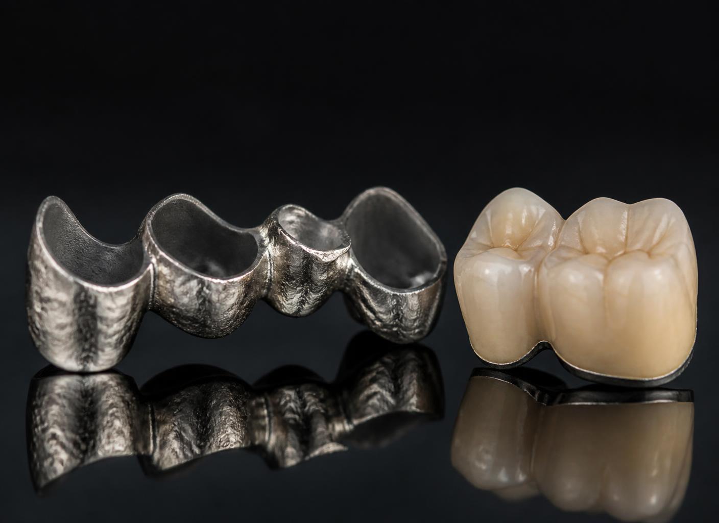 Estructura de cromo-cobalto y corona de metal-cerámica terminada